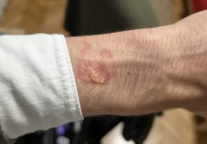 Galaxy Watch, segnalati segni simili a bruciature sul polso dopo l’uso notturno: timori per il surriscaldamento